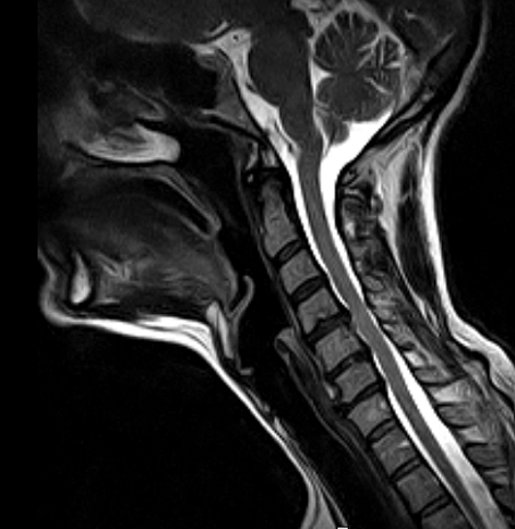 Cervical Spine Neutral MRI scan